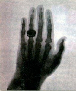 Фотография руки Анны Рентген в икс-лучах. Фото 1895 г.